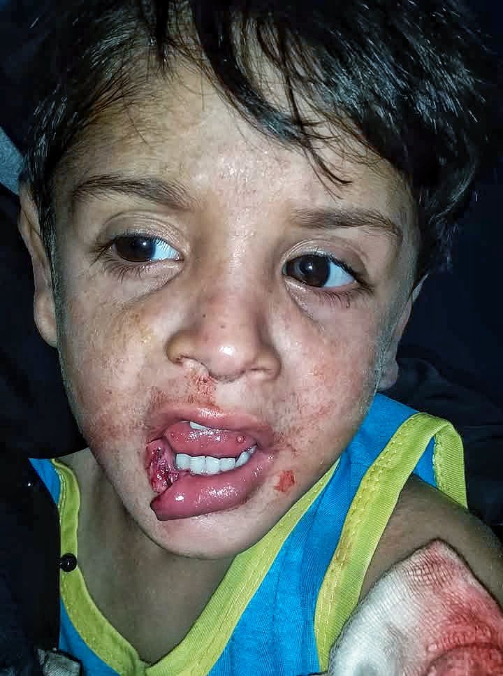 rv20g__'s tweet image. This is my little child. We were walking on the road. He was injured by a shrapnel from a rocket explosion that exploded on the side of the road. He is now suffering and cannot eat or drink. He is in a lot of pain. My heart is breaking for him. Help me 
social.fund/hbnocf/?sw=2