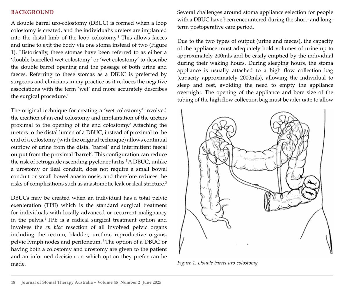 Tarik Sammour (@tarik_sammour) on Twitter photo Great paper by <a href="/RAHcolorectal/">RAH Colorectal Research Group 🫐</a> stoma nurse, Amy Foreman.
DBUC's are a relatively new stoma configuration but becoming more common in exenteration surgery.
Ongoing work here is extremely helpful for us as surgeons, and for the patients who manage these.
search.informit.org/doi/10.3316/in… Great paper by <a href="/RAHcolorectal/">RAH Colorectal Research Group 🫐</a> stoma nurse, Amy Foreman.
DBUC's are a relatively new stoma configuration but becoming more common in exenteration surgery.
Ongoing work here is extremely helpful for us as surgeons, and for the patients who manage these.
search.informit.org/doi/10.3316/in…