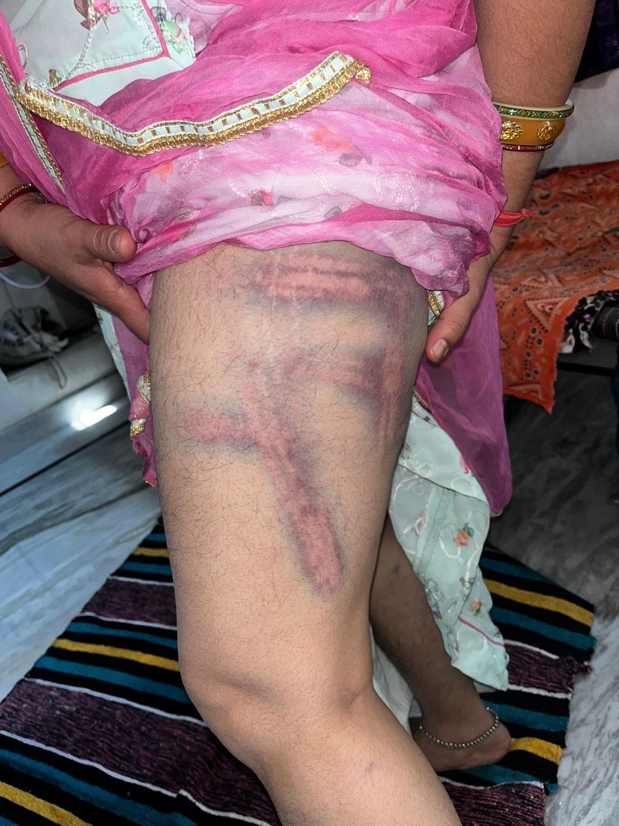 दुःखद - बेटी माँगे  न्याय 😢

एक समाज की बेटी की निर्मम हत्या ....

कमला पत्नी मुकनाराम थोरी सनावड़ा ..!
हाल निवासी बलदेव नगर बाड़मेर की मार मार कर निर्मम निर्दया से हत्या कर शव बाथरूम में  रस्सी से लटका दिया!!
और  पीहर पक्ष के आने से पहले पुलिस और हत्यारो ने मिलकर लाश को