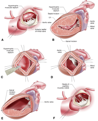 Read Konstantinov IE, Fricke TA. A paradigm change in surgical management of the apical hypertrophic cardiomyopathy tp avoid heart transplantation. J Thorac Cardiovas Surg 2025;169:1785-6.