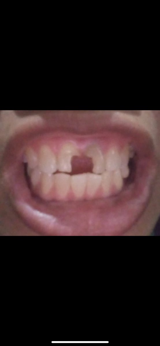 divdivdivdiva's tweet photo. hai, ak koas rsgm moestopo, tanah kusir lg cari pasien kondisi gigi seperti ini n mau perawatan, kalo temen/keluarga/kalian sendiri mau boleh ya dm aku aja!GRATIS dan AMAN!( supervisi dr spesialis) #doktergigi #caripasien #zonauang️ #jokitugas #cabutgigi #zonajajan #Jokiskripsi https://t.co/mh8cPQlWvn