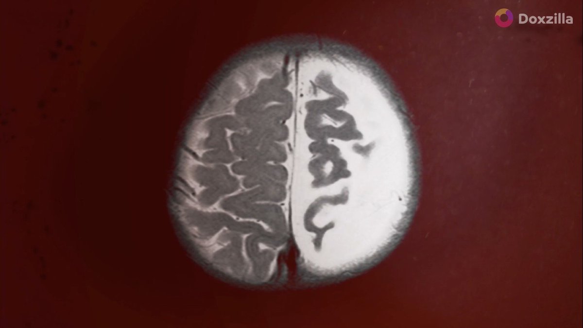 สมองเป็นกล้ามเนื้ออย่างหนึ่งที่บอกถึงฉลาด ในตอนที่เราอายุได้ประมาณ 3 สัปดาห์ในครรภ์ ช่วงนี้เอง สมองเริ่มเกิดขึ้น มันเป็นจุดเริ่มต้นของการเปลี่ยนแปลงจากเซลสมองเล็กๆ มาเป็นเครือข่ายเซลสมองนับพันๆล้านเซลที่อยู่ในหัวของเรา
 ดูเรื่องเต็มที่ doxzilla.page.link/EvHr