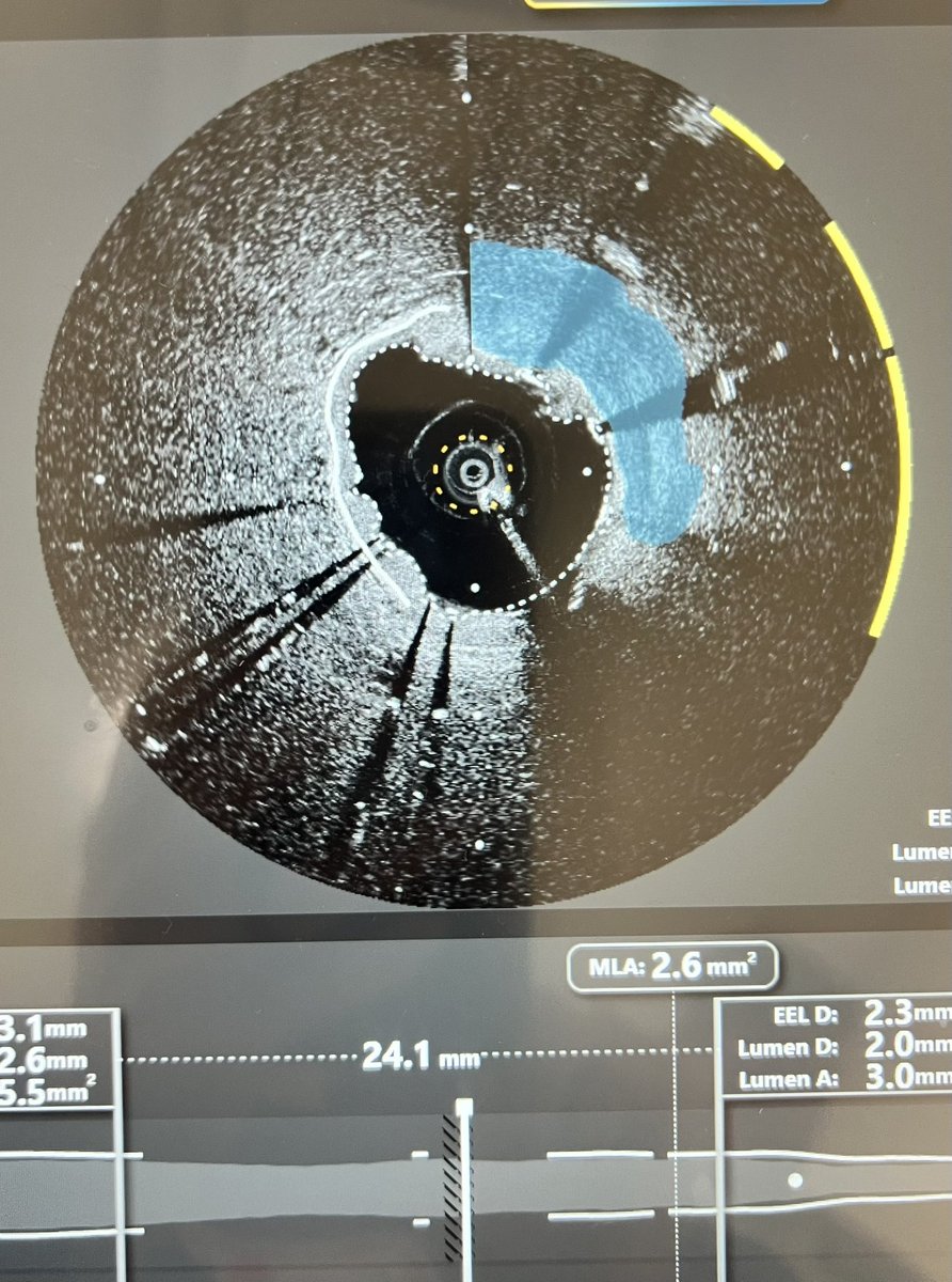 YChatzizisis's tweet image. The cardiovascular program @UMiamiHealth keeps innovating: First use of OCT/NIRS @SpectraWAVE_Med. in the state of Florida. Among the very few Centers in the country that offer this technology!
#Exciting times! #PrecisionPCI!