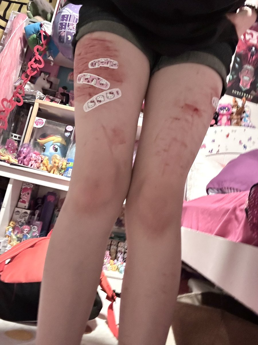 My legs after cutsesh with bro ^^