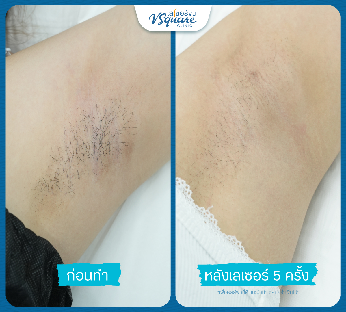vsquareyag's tweet photo. ✨รีวิว เลเซอร์รักแร้ ที่ V Square Clinic  
 ทำไป 5 ครั้งเป็นยังไง มาดูกัน!!  

เลเซอร์ขนรักแร้ • 1 ครั้ง ราคา 699.- 
• 3 ครั้ง ราคา 1,800.- 
• 5 ครั้ง แถม 2 ครั้ง ราคา 2,990.- (ทำได้นาน 1 ปี) 
• 12 ครั้ง แถม 2 ครั้ง ราคา 5,490.- (ทำได้นาน 2 ปี)  

✅เครื่องเป่าลมเย็น Cryo 7 จากเยอรมัน ความเย็นสูงสุดลบ 30 องศา ดูแลและยิงเลเซอร์โดยนักกายภาพ 
✅มีความรู้ด้านกายวิภาค วิเคราะห์เส้นขนแม่นยำ 
✅จองคิวนักกายภาพตอนนี้เลย 
✅ปรึกษาฟรี ไม่มีค่าใช้จ่าย 
✅ราคาตรงไปตรงมาและคุ้มค่าที่สุด 
✅พร้อมให้บริการแล้ว 20 สาขา  

👉สนใจแอดไลน์ https://t.co/eFCQQ3R4pv    

#กำจัดขนรักแร้ #เลเซอร์รักแร้ #เลเซอร์ขน #เลเซอร์ขนวีสแควร์