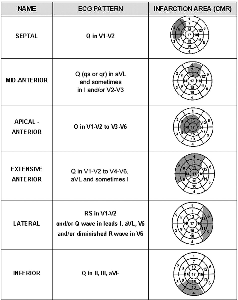 ECG Clues to Localizing Myocardial Infarction (MI): What the Q waves tell us

Different infarct locations produce distinct ECG patterns and CMR helps confirm the myocardial territory involved.

Here’s a breakdown of the 6 major types of Q-wave MI 👇