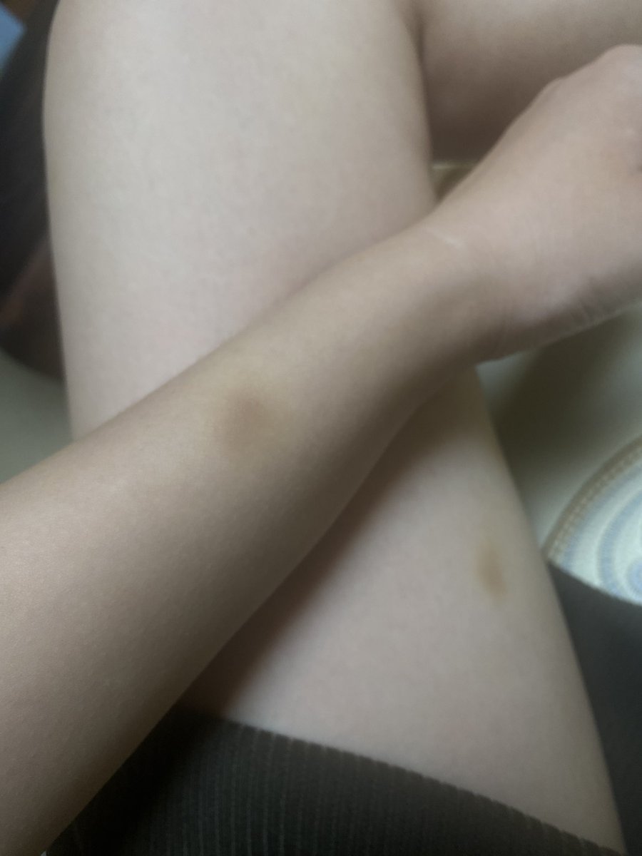 去按摩被问怎么这么多淤青