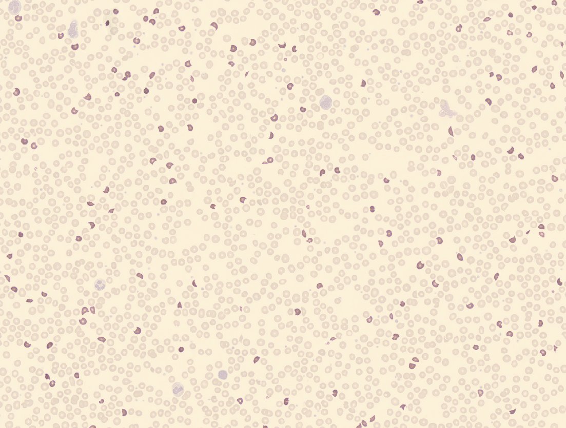 Abrumadora esquistocitosis en este paciente con síndrome hemolítico urémico mediado por E. coli, 7,4%. Imagen de CellaVision, <a href="/Sysmex_Es/">Sysmex España</a> 
#SHU