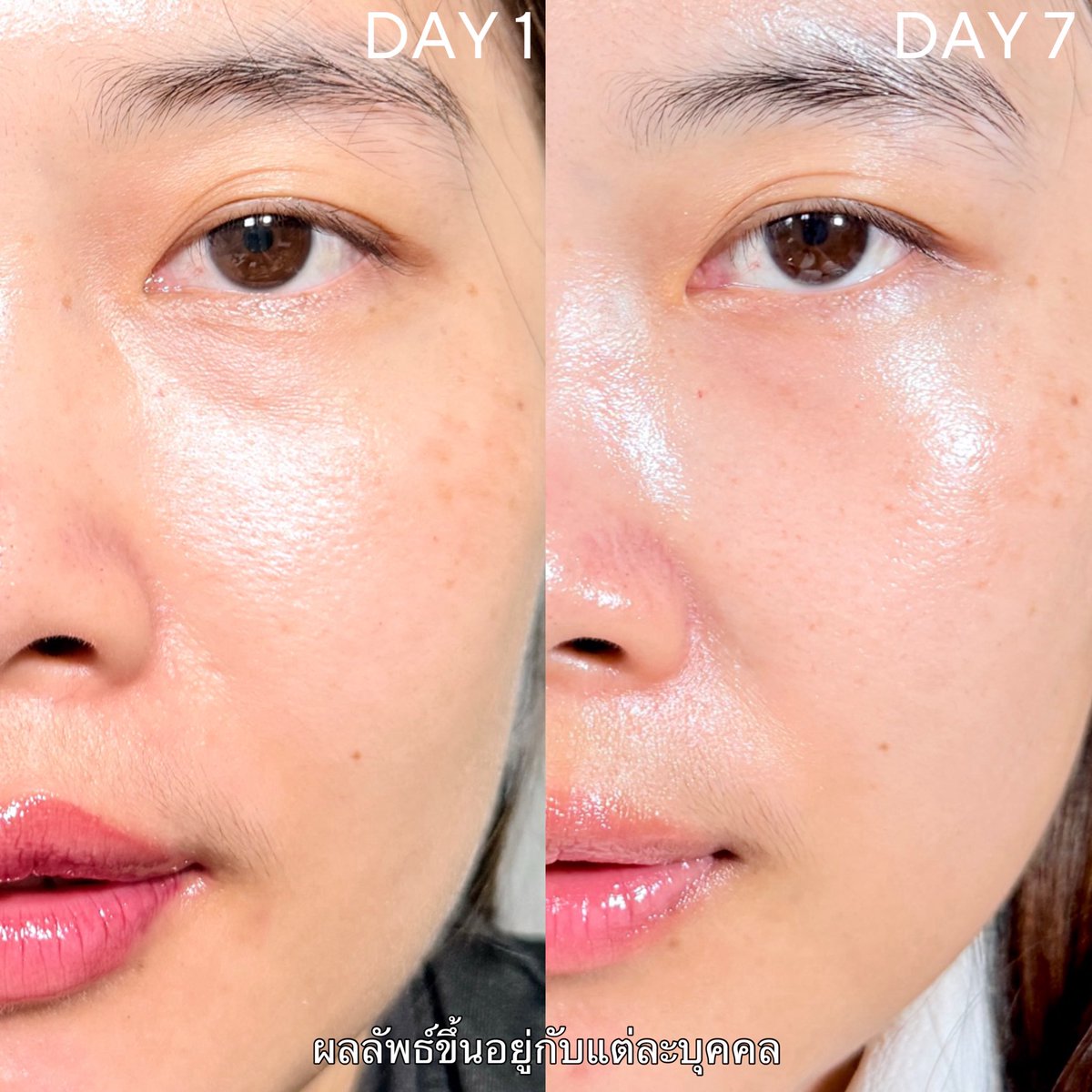 Phanbie's tweet image. 💚✨อยากผิวเนียนผ่อง สายประหยัด แนะนำตัวนี้ๆ เซรั่ม Garnier Tri - Acid Serum ตัวเนื้อบางเบา ซึมง่ายสบายผิว หลังใช้ทันทีผิวชุ่มชื้นมั่กๆ 💖✨ตัวนี้นางมี 10% PHA-AHA-BHA ค่อยๆผลัดเซลล์ผิวที่ตาย ใช้ต่อเนื่องเรื่อยๆรูขุมขนกระชับขึ้น ตรงหน้าแก้มนี่เห็นชัดเลย 💖✨ที่เริ่ดคือนางใส่ 5%…