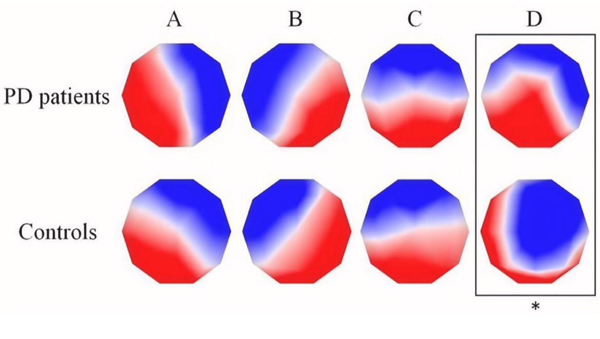 ParkinsonismD's tweet image. Review article PRD Jul 2025
Application of EEG microstates in Parkinson's disease
#EEG #microstates #PD #Parkinson #review
@PRDAssociation
Log in:
prd-journal.com/article/S1353-…