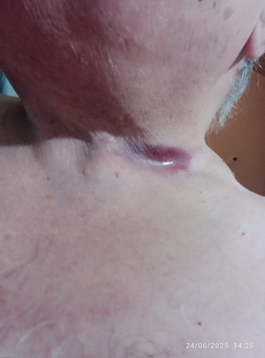 diep_flors's tweet photo. AYUDA Presidenta @Claudiashein
@GobiernoMX
@Defensamx1 ya son 11 años 24/7 que agresor electrónico y cómplices en Tecno del estado, me atacan!!! Yo adulto vulnerable,me acaban de inducir criminal pesadilla, antenoche Jun24 por 3a vez me quemaron!!!#Amenazas #V2k #GobiernoDeMéxico https://t.co/7UAfihjd3h