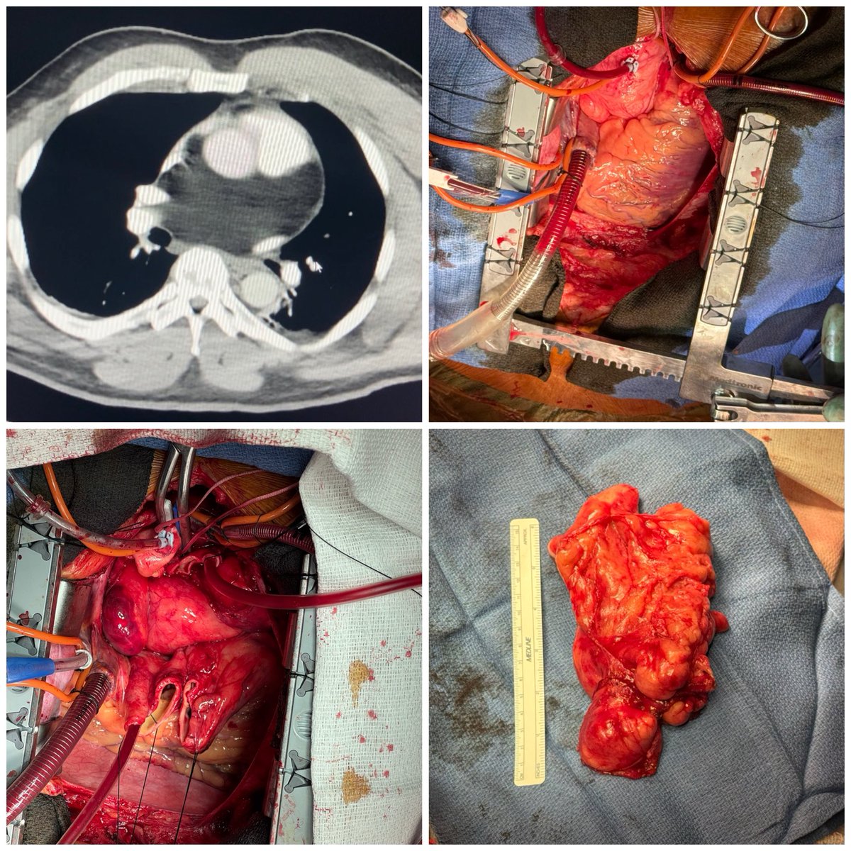 Another rare case : middle mediastinal lipoma abutting carina, esophagus, left atrial dome, SVC and encasing LMCA, requiring transection of aorta and main PA and caudad rotation of the heart for excision. Suckers in pic.3 are in aorta and PA bifurcation.