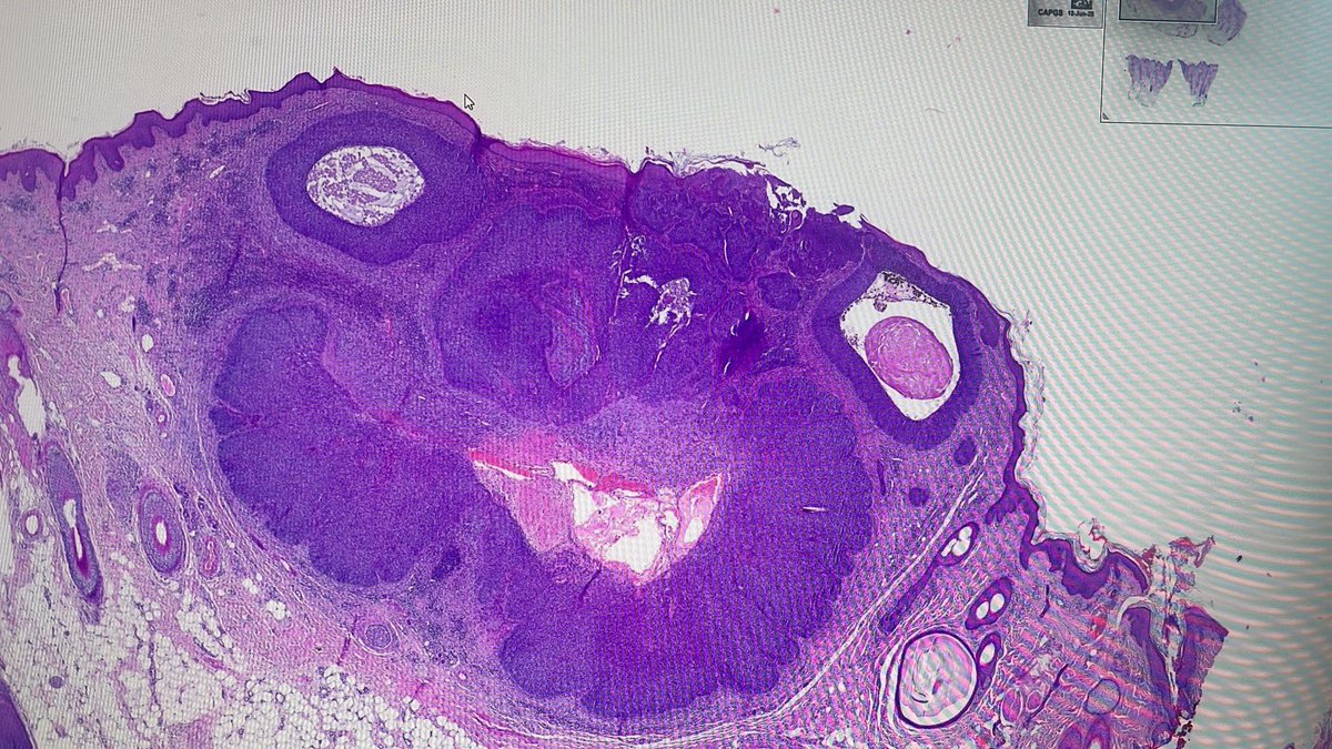 BCC May have a wide range of morphologies! I Will call this pig face like BCC!