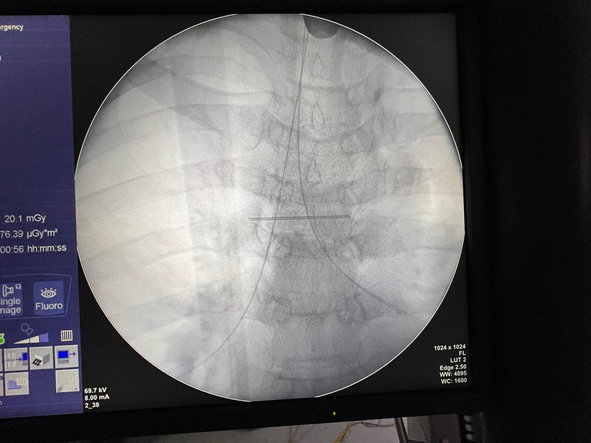 Javier Perez Pallares #Neumologia (@jpallaresneumo) on Twitter photo A VECES SALVAR UNA VIDA ES SÓLO DECIR “SI”
Desde un hospital español nos pidieron ayuda urgente para un caso gravísimo: un cáncer cerrando la vía aérea.
A través de la <a href="/F_PEREZPALLARES/">Fundación Dr. Pérez Pallarés</a> acudimos para colocar 1 prótesis urgente.
Hoy el paciente respira con normalidad 🫶🏻🫶🏻🫶🏻🫶🏻 A VECES SALVAR UNA VIDA ES SÓLO DECIR “SI”
Desde un hospital español nos pidieron ayuda urgente para un caso gravísimo: un cáncer cerrando la vía aérea.
A través de la <a href="/F_PEREZPALLARES/">Fundación Dr. Pérez Pallarés</a> acudimos para colocar 1 prótesis urgente.
Hoy el paciente respira con normalidad 🫶🏻🫶🏻🫶🏻🫶🏻