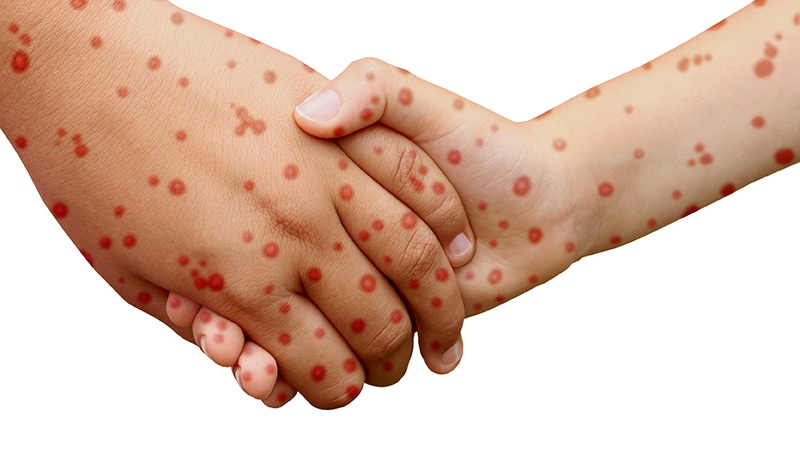 Rougeole : l’année 2025 est mal partie ! #MedTwitter
ms.spr.ly/6011SI44J