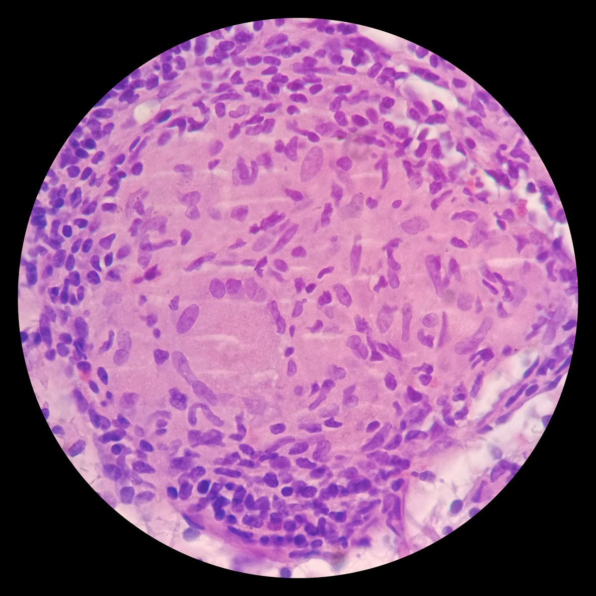 🦀 Medical record: High Grade Urothelial Carcinoma.
🫁 Enlarged Mediastinal Lymph Node.  Suspicious for metastases.
❄️ CryoEBUS.
🔬 Non Necrotizing Granulomatous Lymphadenitis.

#ListenToThePathologist
#LungPath #PulmPath