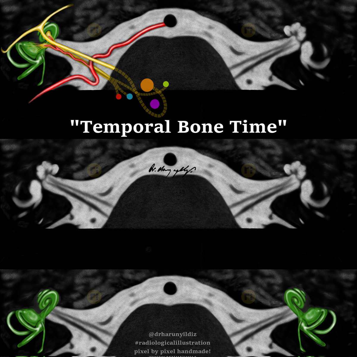 drharunyildiz's tweet image. "Temporal Bone Time"
#radiologicalillustration ✍️
pixel by pixel handmade!