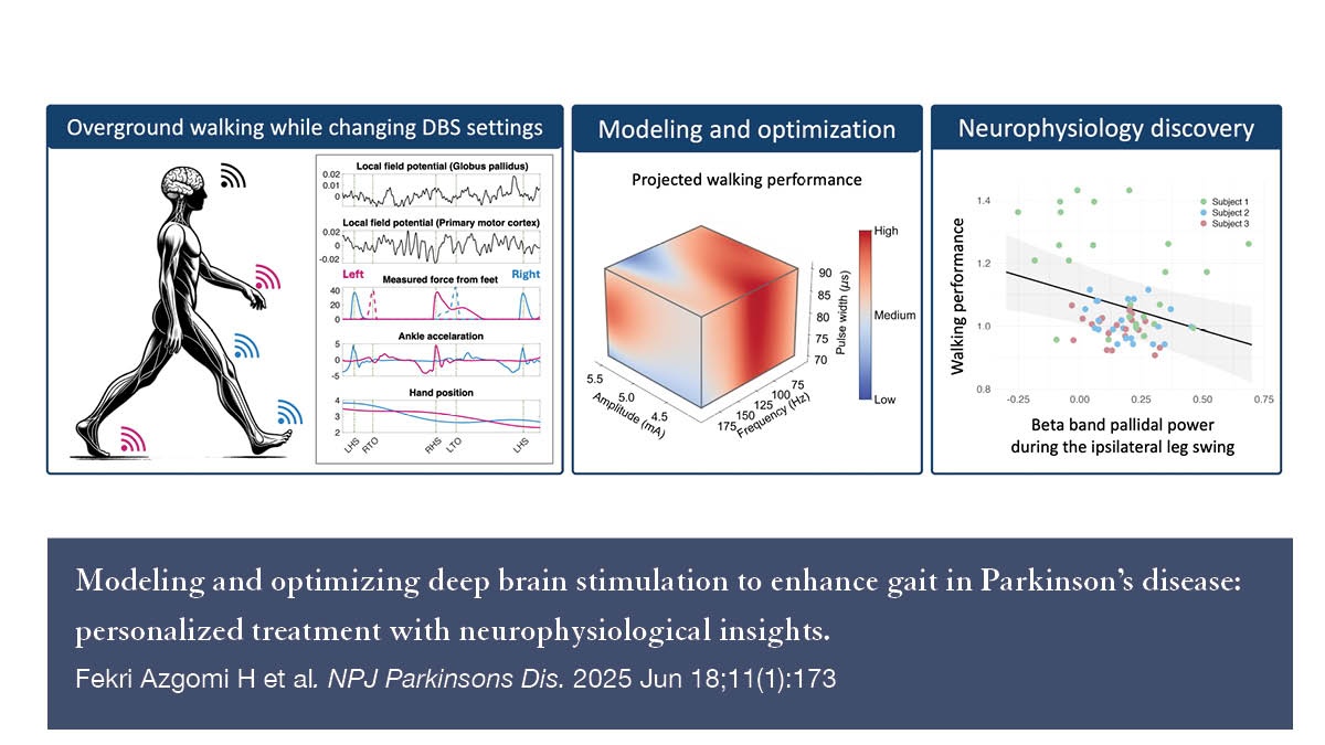 UCSF Neurosurgery (@neurosurgucsf) on Twitter photo New in <a href="/Nature_NPJ/">npj Journals</a>, <a href="/DorisWangLab/">Doris Wang</a> presents an AI approach for identifying personalized deep brain stimulation (DBS) settings to improve walking in people with #Parkinsons. Their findings lay the groundwork for adaptive DBS systems that adjust in real-time: nature.com/articles/s4153… New in <a href="/Nature_NPJ/">npj Journals</a>, <a href="/DorisWangLab/">Doris Wang</a> presents an AI approach for identifying personalized deep brain stimulation (DBS) settings to improve walking in people with #Parkinsons. Their findings lay the groundwork for adaptive DBS systems that adjust in real-time: nature.com/articles/s4153…