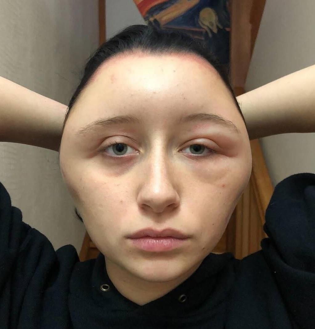 Del_Lort's tweet photo. New trend in Slavic countries: mosquito bites near the eyes. Apparently some guys find it attractive. https://t.co/XO36wA3V8n