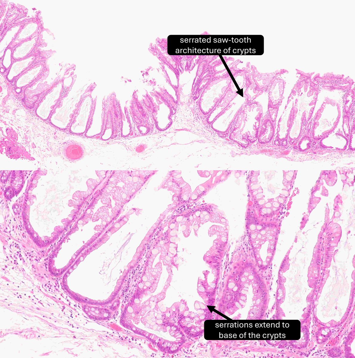DrCycloPath's tweet photo. The key is the abnormal crypt architecture at the base (classic "boot-shaped" crypts).

What is the most characteristic gene mutation?

A) APC
B) STK11
C) KRAS
D) BRAF
#PathTwitter #Pathology #GIPath
WSI https://t.co/ZRhbHO6Nv4