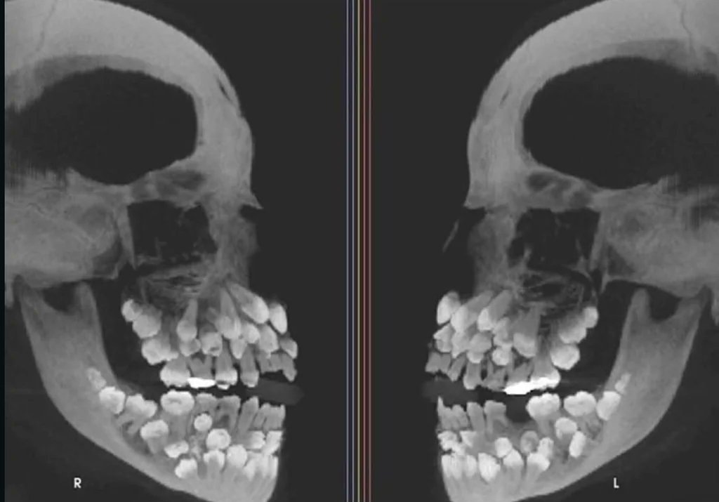 An x-ray of a patient with hyperdontia (the condition of having more teeth than average). 

In a rare and extraordinary dental case from Brazil, an 11-year-old girl was found to have 81 teeth.