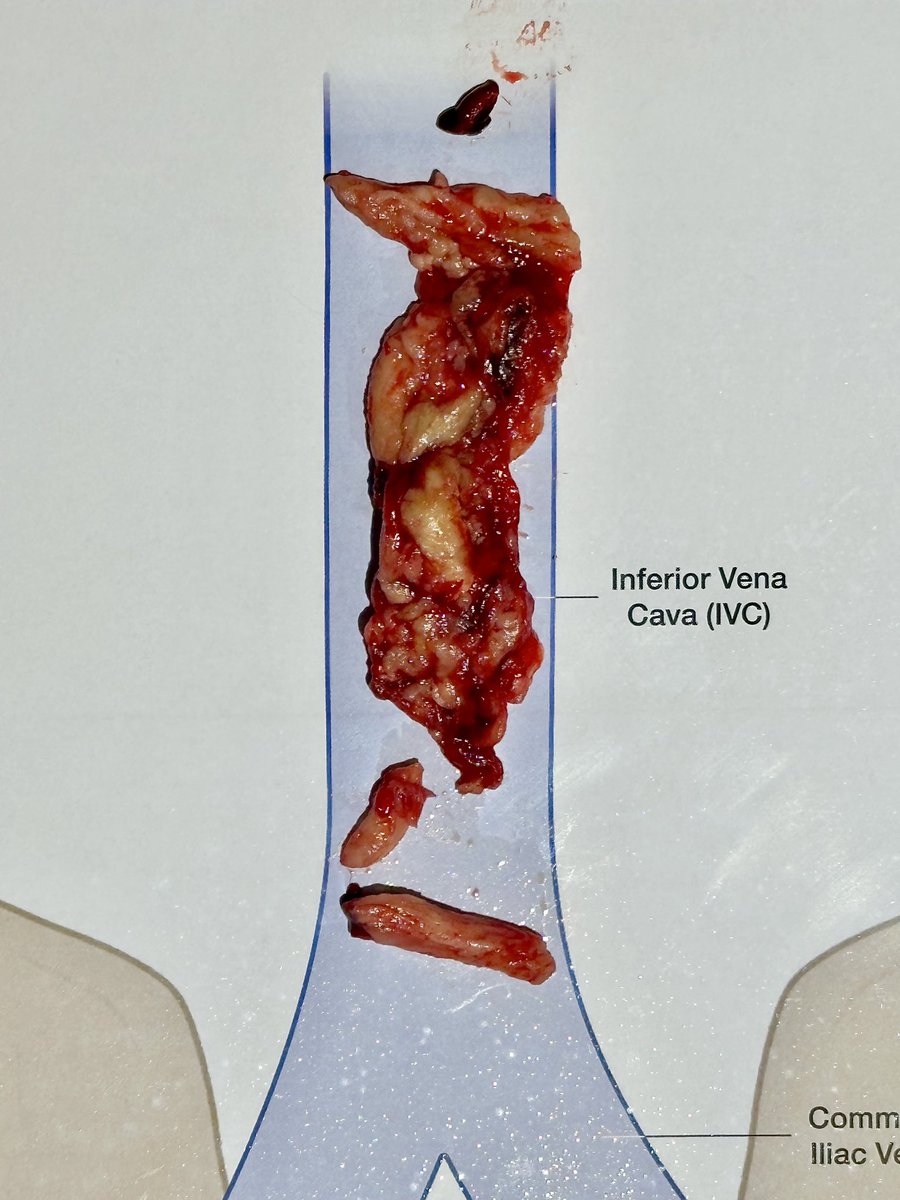 DrJayMohan's tweet photo. 7 Final- IVC clear. Amazed at how chronic the clot was that was removed. Filter to be removed once clinically stable.
Overall impressed with speed of device and also torquebility of catheter and advantage of aspiration off sheath #Flash16
#VTE #DVT #CardioX #Irad #Vasctwitter https://t.co/19lU2HHMSU