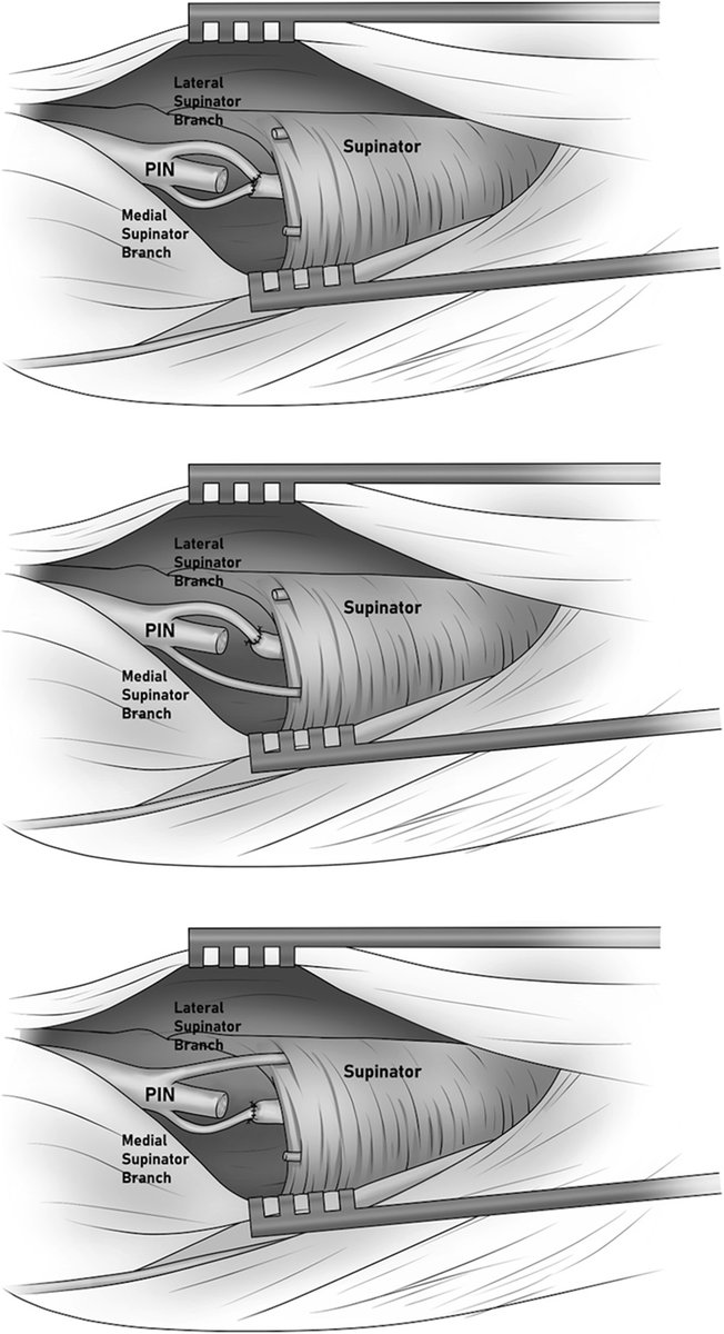 ColinFranzMDphd's tweet image. 2 new papers from our team related to complex nerve injury care! 1️⃣ Double supinator branch transfer in SCI & brachial plexus injury (Texakalidis et al. Oper Neurosurg. 2025. 10.1227/ons.0000000000001670) &2️⃣ Nerve injury recovery similar in COVID-19 vs non-COVID…