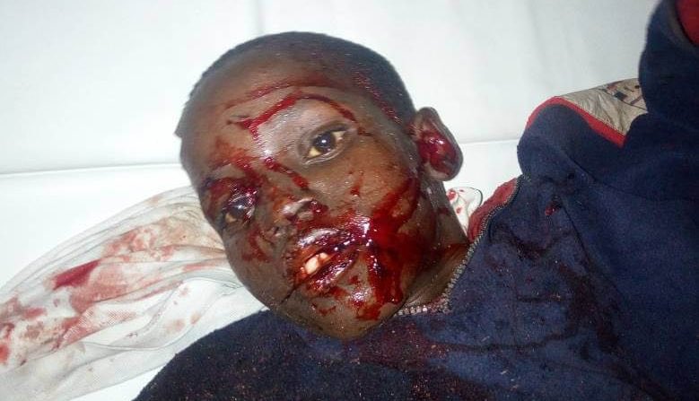 #TOGO UN JEUNE DE 14 ANS TABASSÉ A ÉCHAPPÉ MIRACULEUSEMENT À LA MORT À ATTIEGOU, DANS UN QUARTIER DE LOMÉ, PAR LES NAZILLONS DU RÉGIME RPT UNIR. FAURE GNASSINGBÉ DOIT PARTIR.