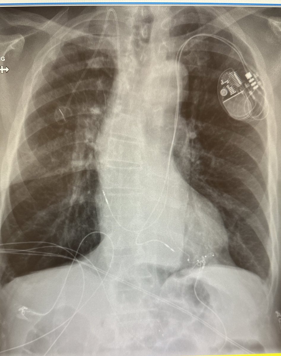 Allen Amorn MD (@allenamornmd) on Twitter photo High degree AVB with right sided port. Lab staff and industry less familiar with this scenario but CRT skills are still worth something 😅. #cardiotwitter #CardioX what is unusual about this picture? <a href="/nsaghirMD/">Nabeel Saghir</a> <a href="/pooneh_nabavi/">Pooneh Nabavizadeh, MD</a> <a href="/uccardiology/">UC Cardiology</a> <a href="/ricardotorresmd/">Ricardo Torres</a> High degree AVB with right sided port. Lab staff and industry less familiar with this scenario but CRT skills are still worth something 😅. #cardiotwitter #CardioX what is unusual about this picture? <a href="/nsaghirMD/">Nabeel Saghir</a> <a href="/pooneh_nabavi/">Pooneh Nabavizadeh, MD</a> <a href="/uccardiology/">UC Cardiology</a> <a href="/ricardotorresmd/">Ricardo Torres</a>