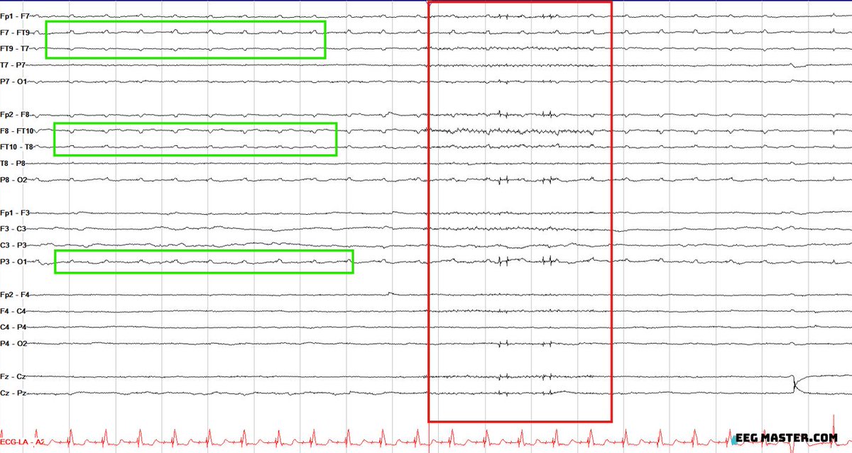 73 yo M on ECMO after cardiac arrest. EEG shows brief non-evolving rhythmic 10 Hz activity bilaterally (red box). What is likely explanation for this EEG finding? Click on the link to view full question, submit answer and view explanation. eegmaster.com/eegmaster/quiz…