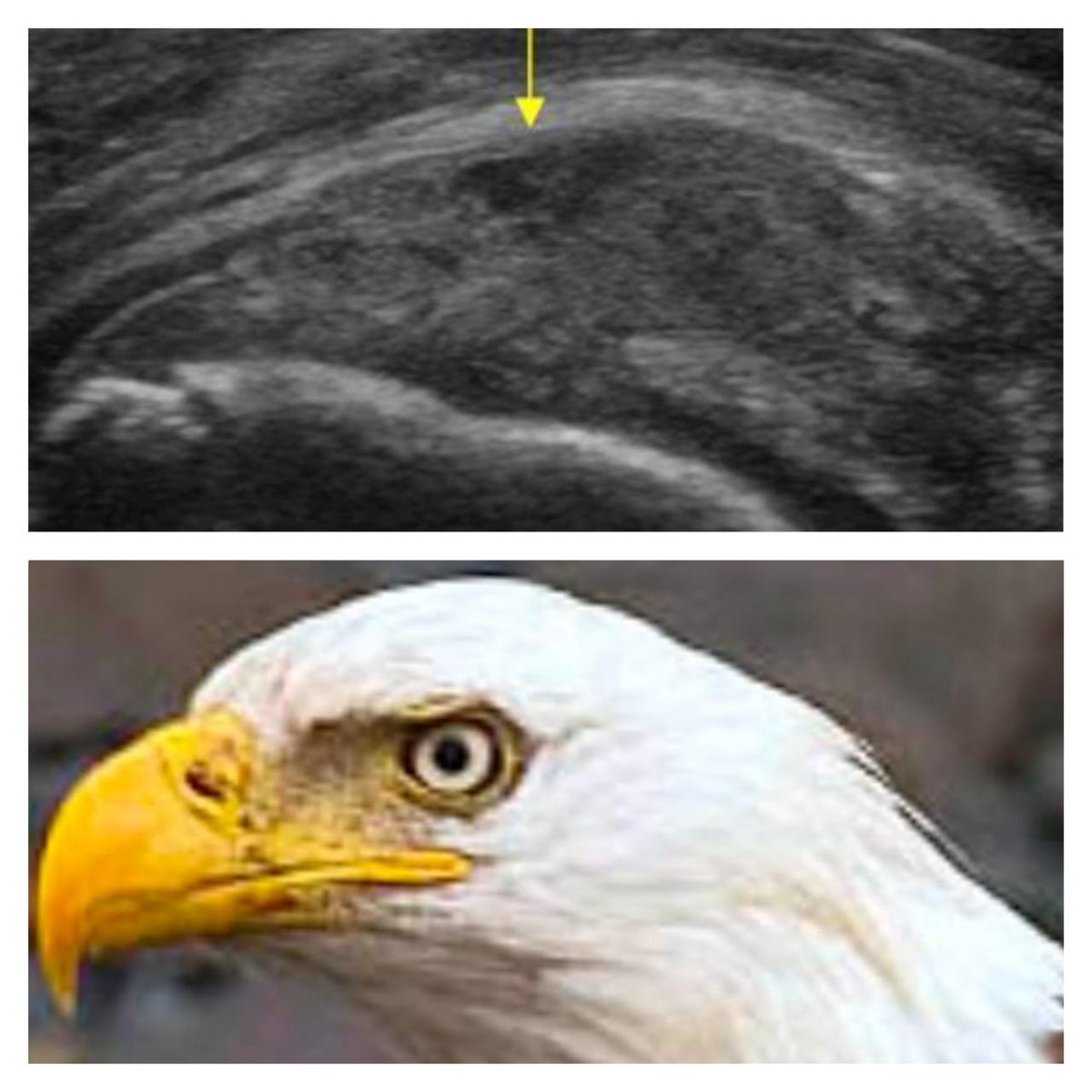 Bursal _sided rotator cuff partial tear =. focus on the eye of victory
تعلم معنا في MSKUS