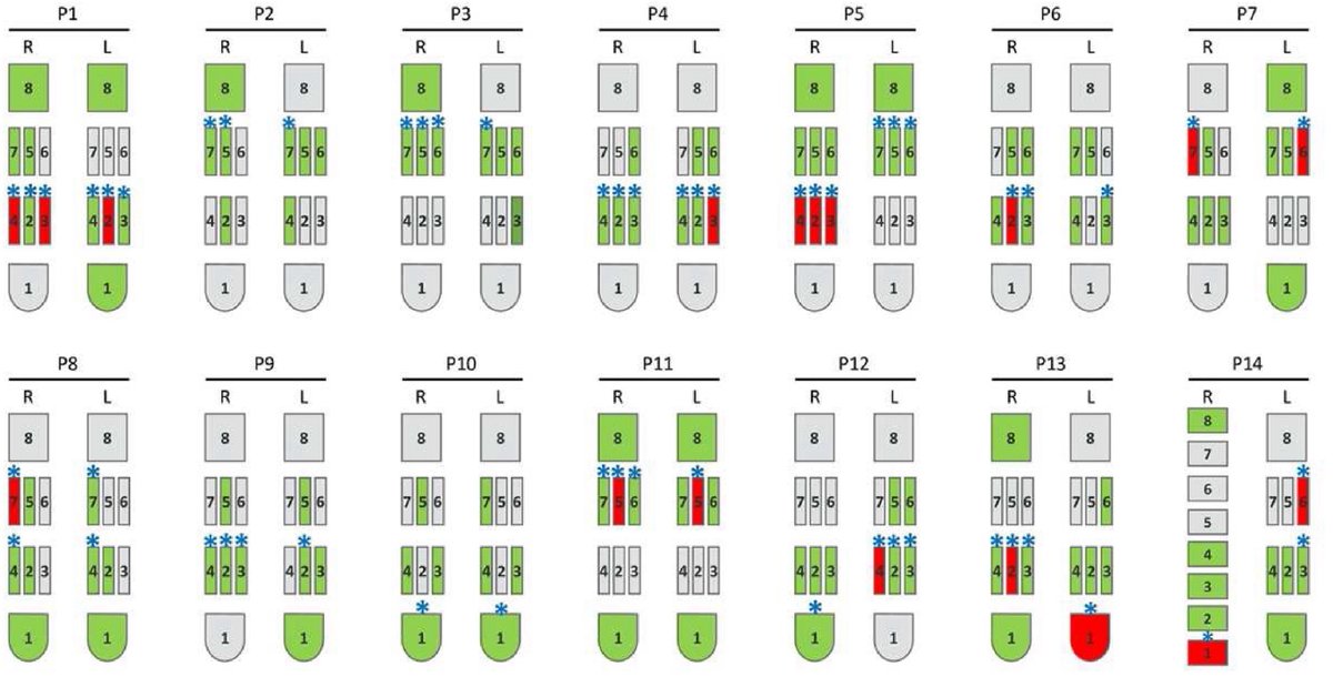 JNeuromod's tweet image. 📖 #FBF 2023: &quot;Intraoperative Local Field Potential Beta Power and Three-Dimensional Neuroimaging Mapping Predict Long-Term Clinical Response to Deep Brain Stimulation in Parkinson Disease: A Retrospective Study&quot; 

👀   sciencedirect.com/science/articl…
 
➡️ DOI: doi.org/10.1016/j.neur…