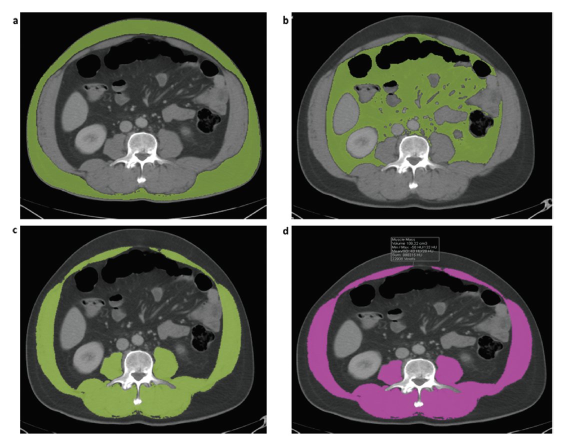 🆕Our latest study is now out in Immunotherapy! 

🧠The albumin–myosteatosis gauge (AMG) is an independent prognostic biomarker in ICI-treated patients
📉 Low AMG is associated with shorter PFS &amp; OS
🎯A practical, accessible, and promising biomarker

🔗 doi.org/10.1080/175074…