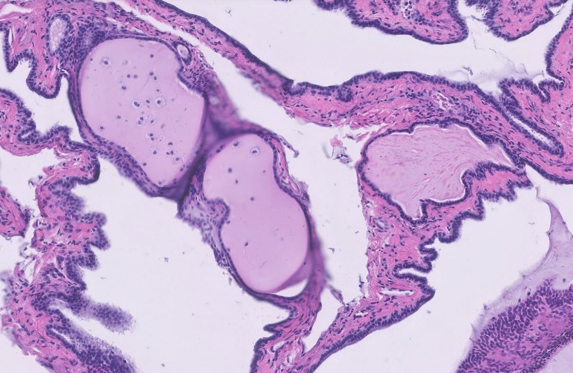 Colloid cyst of the 3rd ventricle. Just because something is b9 does not mean you can ignore it! What’s the classic clinical presentation of these lesions? #neuropath #neuropathology #cnspathology #pathtwitter #pathx