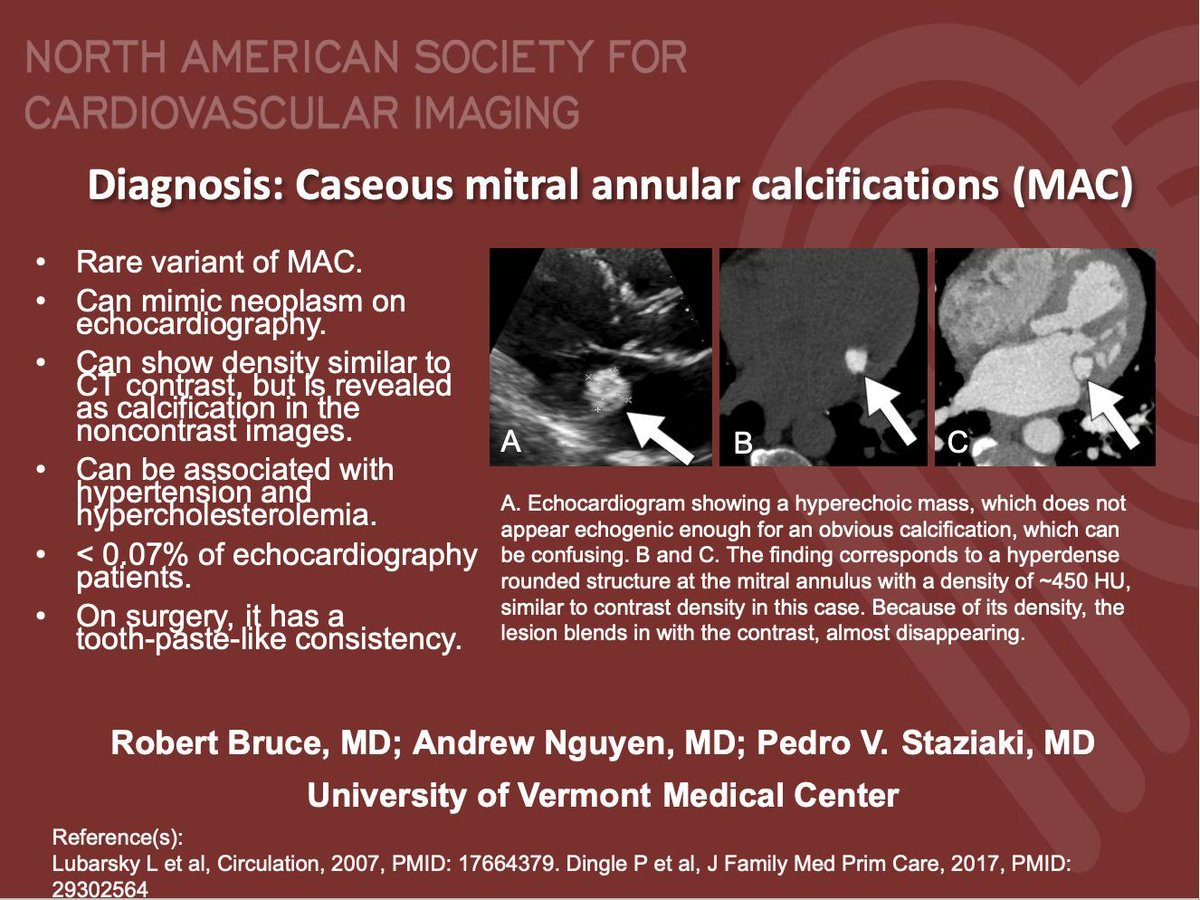 NASCISociety's tweet image. #NASCI Case Series
Case 83 Diagnosis
Courtesy of Pedro V. Staziaki @staziaki from University of Vermont Medical Center
#whyCMR #YesCCT
@GregKicska @JRevRad1 @dianalitmano @DanielVargasMD @kirschj @prachipagarwal @AwsHamid5 @EscrOffice @CarlottaOnnis @DeCeccoCN