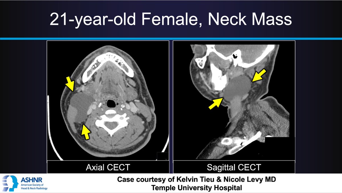 ASHNRSociety's tweet image. #ASHNRCOTW #303: ANSWER. Thx Kelvin Tieu and Dr. Levy 4 case! #ASHNR25
@callyrobs @DShatzkes @CDP_Rad @rhwiggins
@nakoontz @KRileyMD @CMGlastonbury @tabby_kennedy @PhilipRChapman1 @cmtomblinson
@amyfjuliano @bpoliceni @MohitTCCNeuro @AshokSrini15 @KatieTraylorDO…
