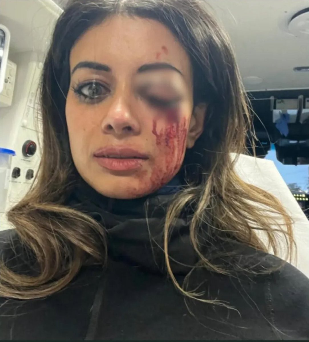 🚨 Former Greens Candidate Hannah Thomas Releases Photo Of Damage Done To Face After Alleged Assault By Police In Sydney At Protest Against Israeli Weapons Manufacturers 🚨

Former Greens candidate Hannah Thomas requires surgery to save her vision after being allegedly brutally