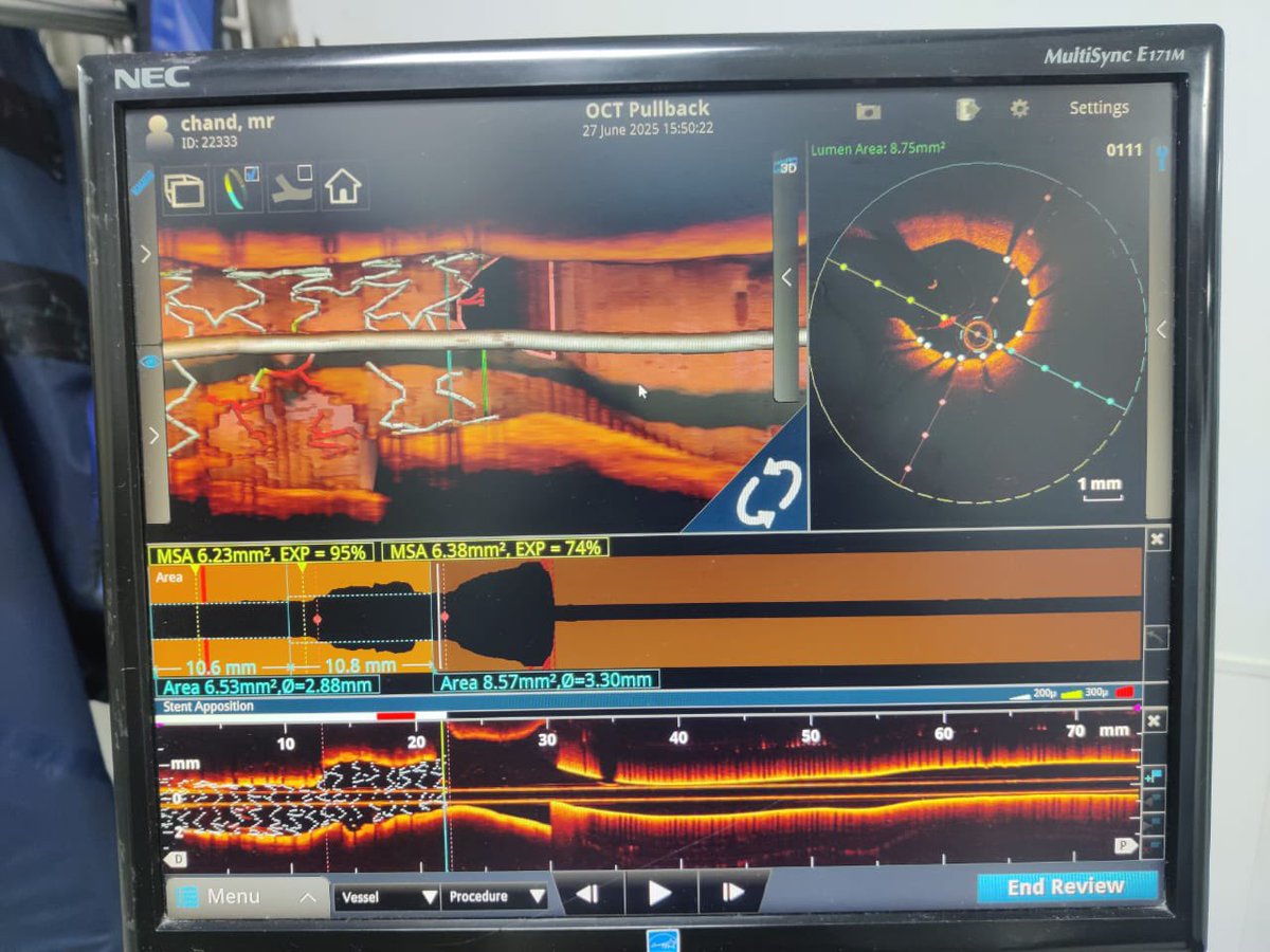 NIC Mumbai 2025. National interventional Council meeting.
We performed two live cases from RHL, Jaipur in the complex coronary angioplasty section, ROTA and OA angioplasty, sucessfully in the both the cases. 
Thanks RHL team for delivering safe results in complex blockages.