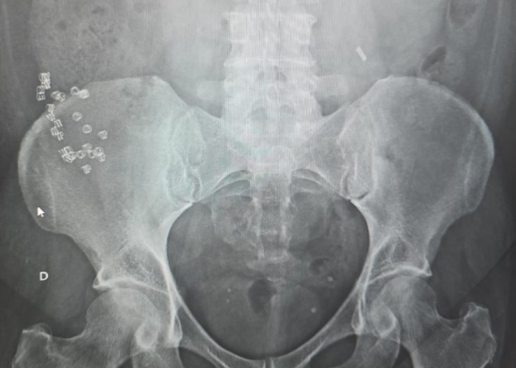 X Ray that I received yesterday during consult with a pt with chronic pain. Prior lap inguinal correction at external facility 2y ago.

This is so wrong in so many levels...