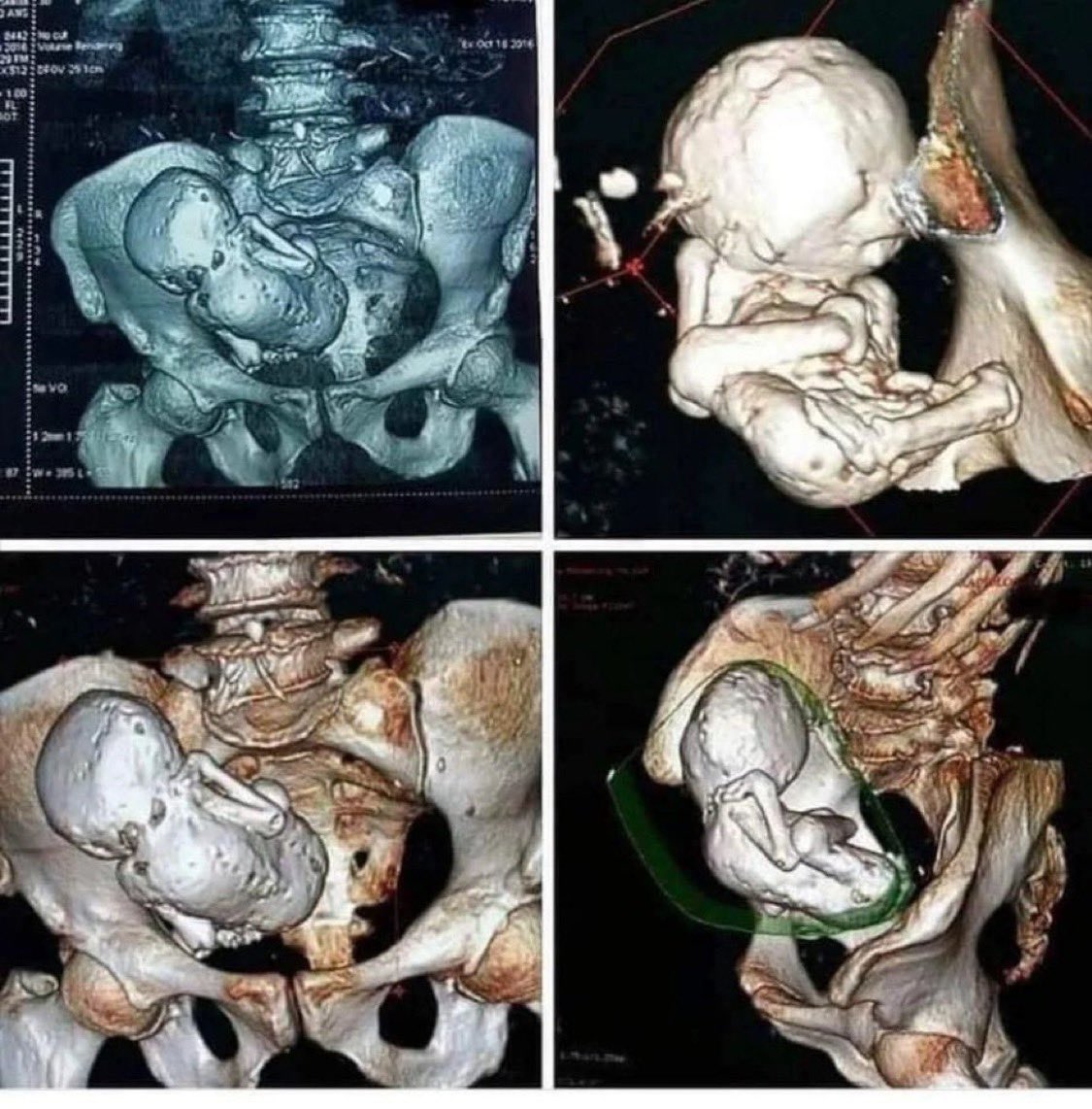 Insane CT scan of an elderly woman discovered to have a calcified fetus still inside her