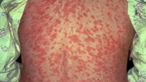 BelizeCommunist's tweet photo. BREAKING: Measles has returned to Belize for the first time since 1991.

Cayo and Corozal Districts have confirmed cases.
How did a disease eliminated decades ago come back?

🧵 A thread on capitalism, healthcare, and human life in Belize.

#Belize #Healthcare #BCP https://t.co/9iUBLEmzAs