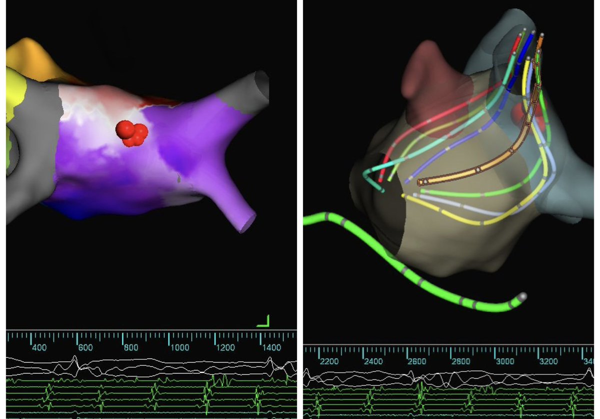 After isolating 4 PVs w/#Farapulse, mapping w/ <a href="/AbbottCardio/">Abbott Cardiovascular</a> #HDGrid resulted in same conclusion as the Cortex <a href="/AblaconInc/">Ablacon</a> map: the atypical #AFL was LA roof dependent. #RFA around trigger terminated tachycardia / rendered it noninducible.
#thingsthatmakeyougohmm🤔
#epeeps