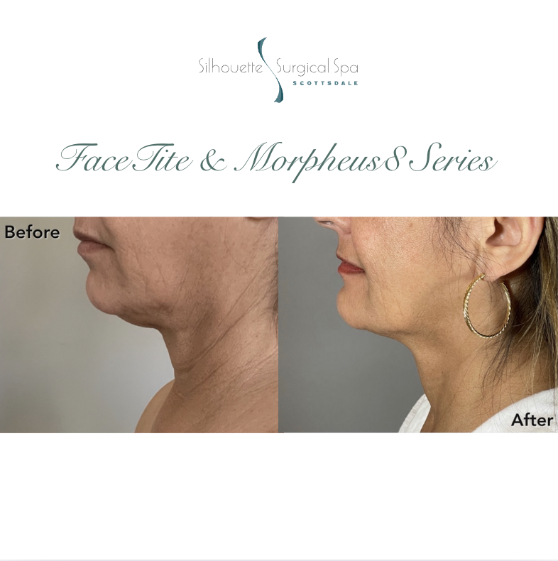 surgicalspa's tweet photo. ✨ FaceTite + Morpheus8 = Lifted, tighter, younger skin 
Sculpt your jawline, smooth your neck, and boost collagen—all with minimal downtime.
📍 Scottsdale, AZ💻 https://t.co/55RQKyTu7Q

#FaceTite #Morpheus8 #NonSurgicalFacelift #SkinTightening #Silhouettesurgicalspa #Collagen https://t.co/LWuBpSP7sW