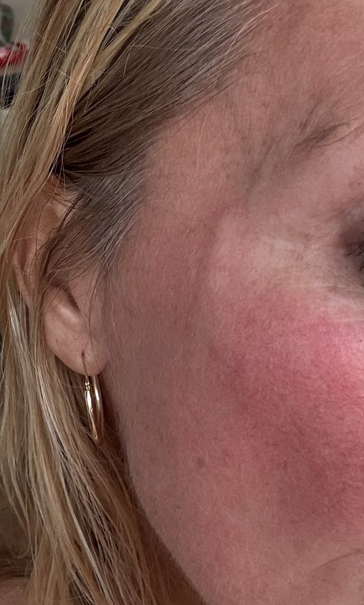 My “abnormality” thing I got an MRI today. There’s this vein that runs down your face and it gets bigger with age or stress. Convinced it’s because my husband is a Democrat.