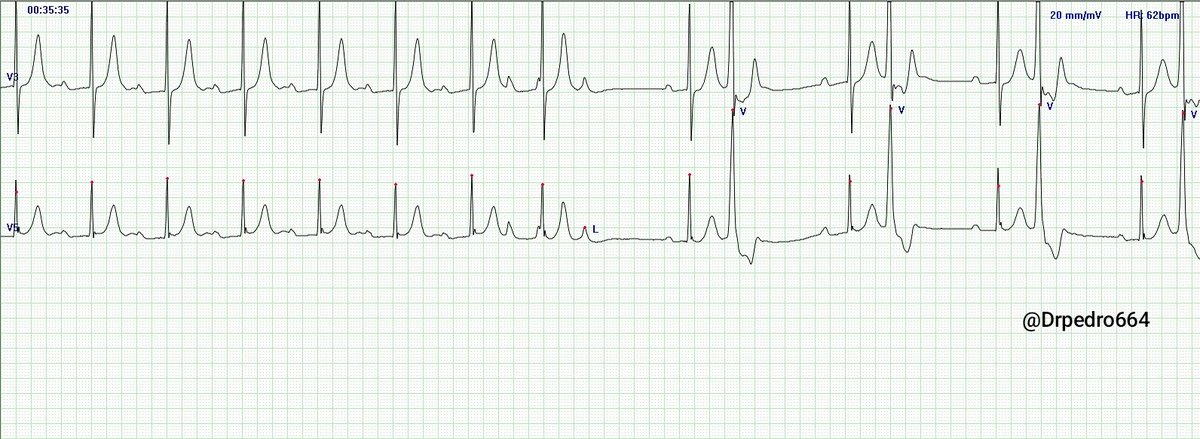 drpedro664's tweet photo. 56 yo man, Holter strip channel, any opinion? https://t.co/tiavwrtH69
