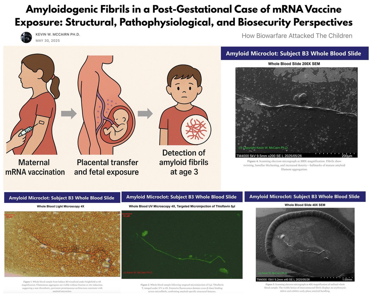 ⚠️REMINDER: Amyloid Fibrils Detected in 3-Year-Old After In-Utero Pfizer mRNA Exposure

The child was born 1 week after mother’s 2nd Pfizer shot—no vital signs at birth, required resuscitation, and has been chronically ill since: recurrent infections, multiple surgeries, immune