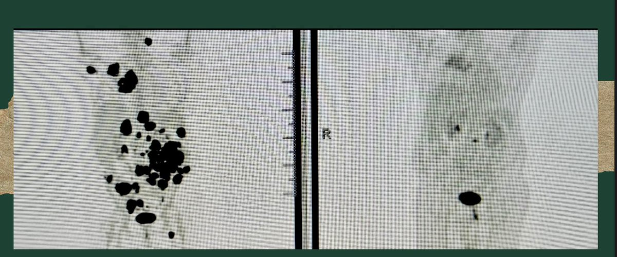 Before and After. Just 8 weeks.
Nope, not lymphoma. 

THIS is non-small cell lung cancer.
THIS is why molecular profiling matters.
THIS is why targeted therapy changes lives.