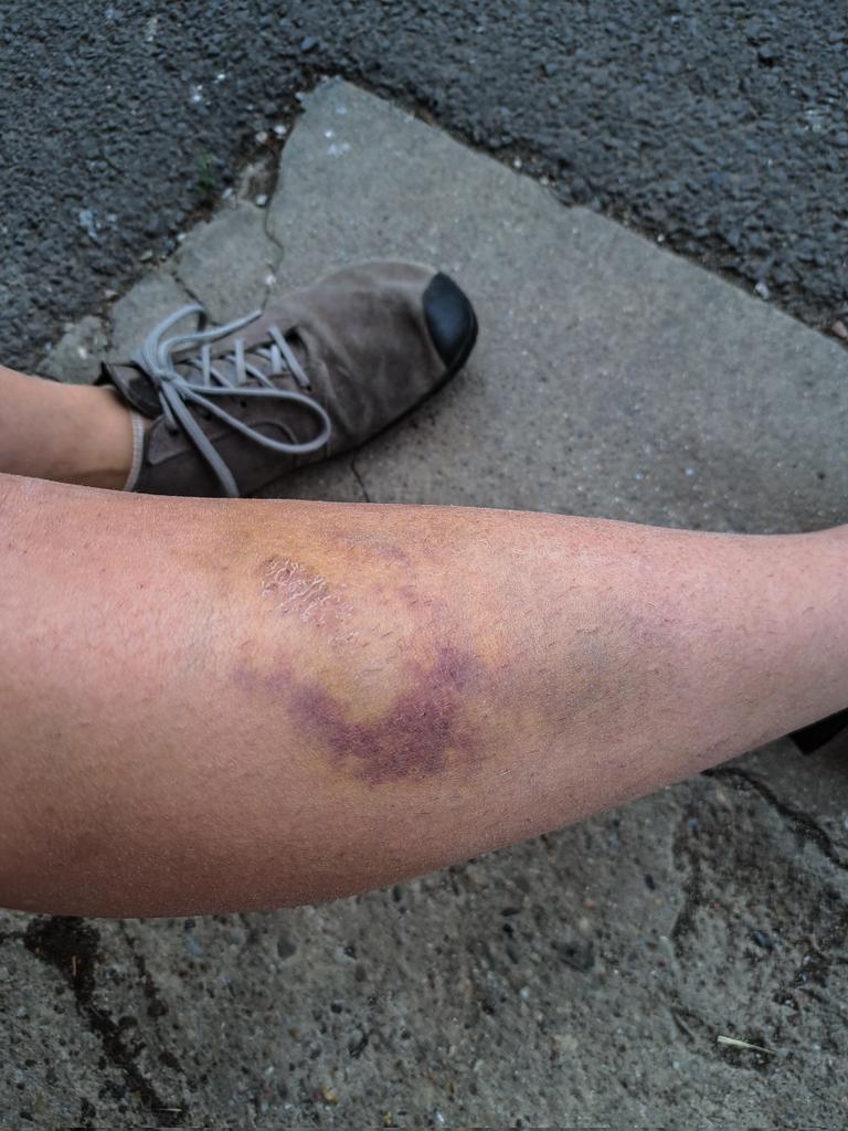 Hnáta. Po týdnu. Bolí furt, jen malinkato míň.
Hihihi 😀