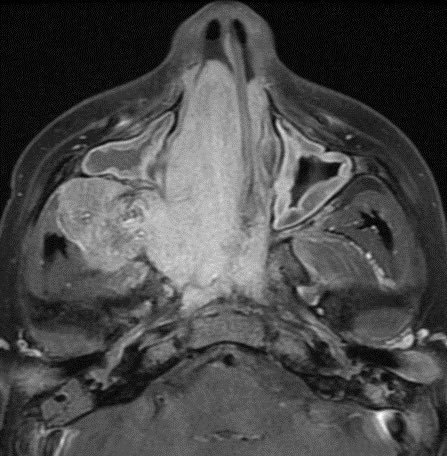 daniel_gewolb's tweet image. ⭐️ Classic case: what’s the most likely diagnosis in this 12 y/o M presenting with stuffy nose and epistaxis?

#ENT #Peds #medicine #radres #futureradres #Neurology #neurosurgery @ASHNRSociety @Radiopaedia