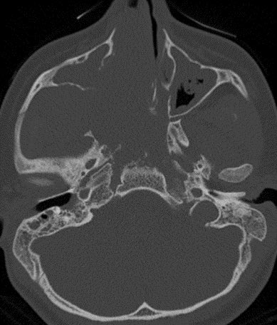 daniel_gewolb's tweet image. ⭐️ Classic case: what’s the most likely diagnosis in this 12 y/o M presenting with stuffy nose and epistaxis?

#ENT #Peds #medicine #radres #futureradres #Neurology #neurosurgery @ASHNRSociety @Radiopaedia